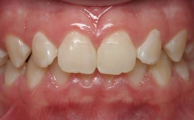 Niềng răng khớp cắn sâu có hiệu quả không?