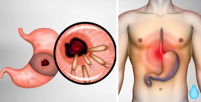 Here's How To Remove The Bacteria That Cause Heartburn And Bloating