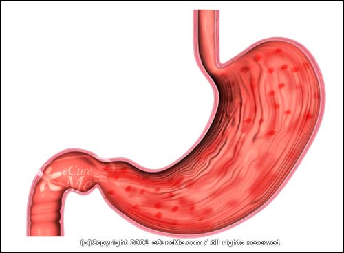 Nursing Diagnosis Interventions Imbalanced Nutrition Less Than Body Requirements - Gastritis