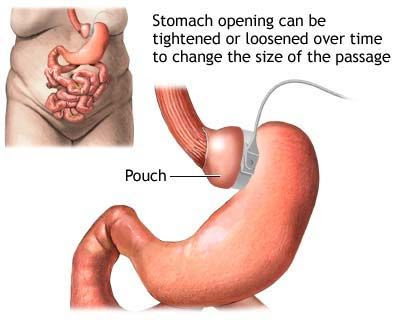 How much does gastric bypass surgery cost?