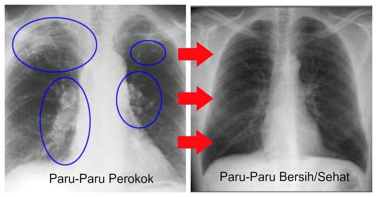 Paru Paru Perokok Bisa Bersih Lagi Hanya Dengan Rajin 