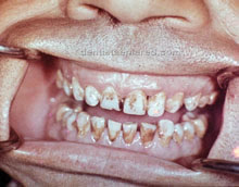 <Img src ="defectos-dentale-por-fluorosis.jpg" width = "220" height "172" border = "0" alt = "Fluorosis dental en paciente cubano.">
