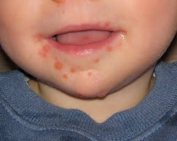 Pharmacotherapy of hand, foot and mouth disease