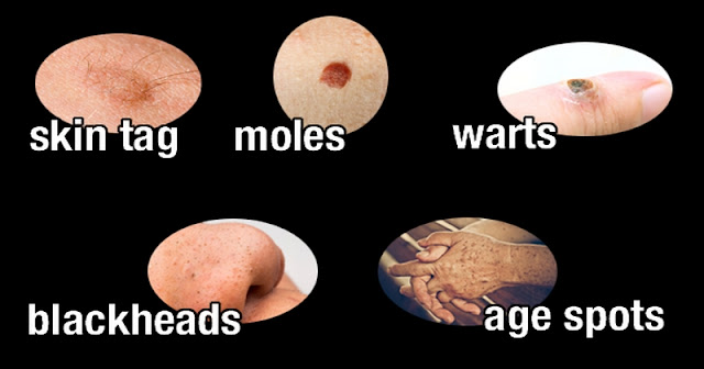 The most effective method to naturally cure skin tags, Moles, Warts, Blackheads, and Dim Spots