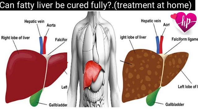 can-fatty-liver-be-cured-without-surgery-hidden-facts.jpg