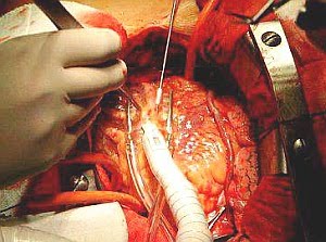 ardiana s Coronary artery bypass graft CABG 