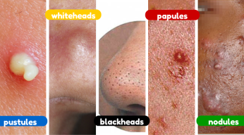 Acne scars vary in size, color and level of pain.  The following types are possible:  Whiteheads: These live under the skin and are small Blackheads: Clearly visible, they are black and appear on the surface of the skin Popules: Small, usually pink bumps that appear on the surface of the skin Blisters: Clear on the skin surface. They are red at their base and pus at the top Nodules: clearly visible on the skin surface. They are large, firm, painful pimples that are deeply embedded in the skin. Cyst: Clearly visible on skin surface. They are painful and fill with pus. Ulcer scars form.