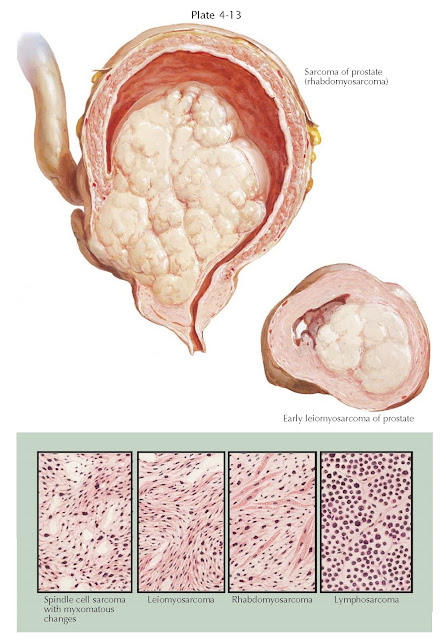 SARCOMA OF PROSTATE