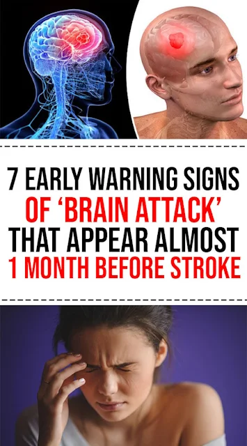 7 Early Warning Signs of ‘Brain Attack’ That Appear Almost 1 Month Before Stroke