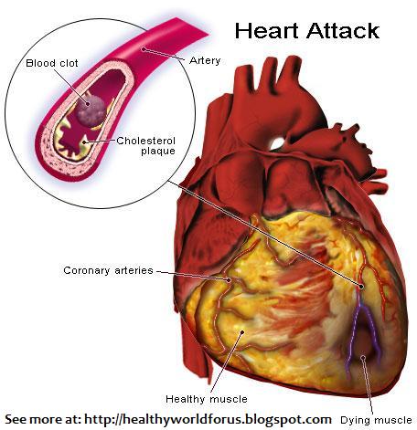women heart attack pain. Heart disease is the No.