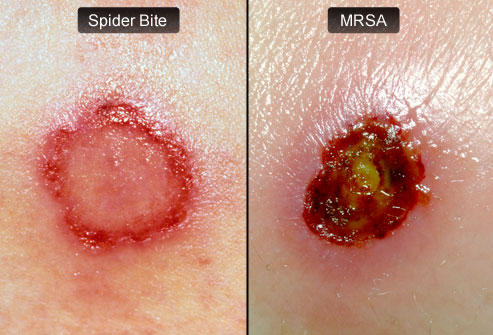webmd rm photo of spider bite and mrsa