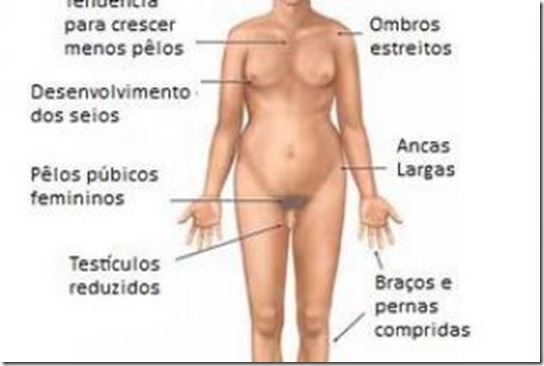 foto-sindrome-turner