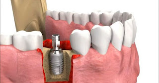Cấy ghép implant cho người mới nhổ răng-3