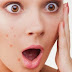 5 Tips to Prevent Acne