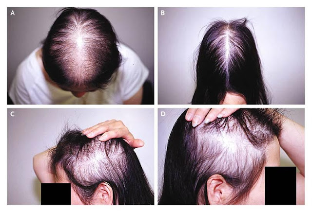 WHAT IS HAIR LOSS?  WHAT DIFFERENCE BETWEEN ALOPECEA AND HAIR LOSS? CAUSES, WHAT IS MAIN REASON OF HAIR LOSS IN FEMALES?HAIR LOSS CAN BE CURED?FRONT HAIR LOSS IN FEMALES, DIET, TREATMENT
