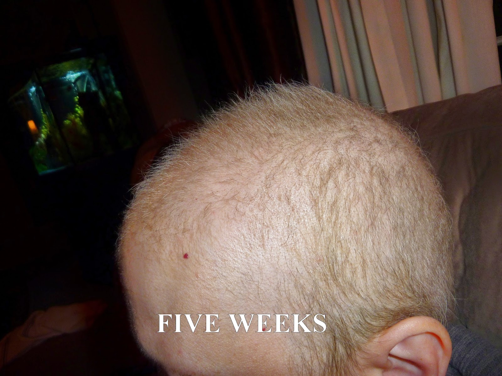 Anncredible Hair Growth Progression After Chemo Six Months With