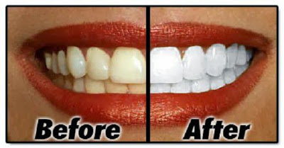 Cách khắc phục tẩy trắng răng bị nhiễm tetracycline