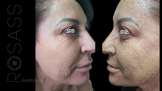 Before and direct After Plasma Fibroblast treatment