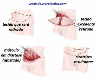 passos da cirurgia de abdome