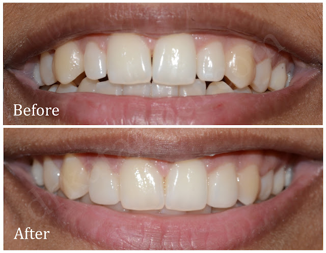 Dental Veneers for small lateral incisors at Dr. Bharat Katarmal Dental Clinic at Jamnagar