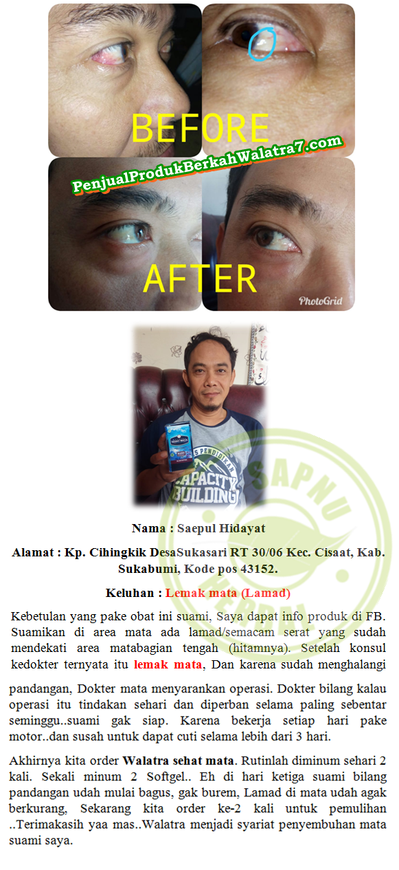 Cara Mengobati Kornea Keruh Secara Alami dan Cepat ~ TESTIMONI PRODUK SEHAT MATA SOFTGEL