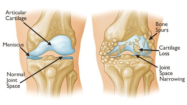 Causes and symptoms of osteoarthritis and methods of treatment | healthy care
