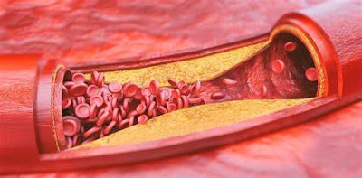 what is atherosclerosis, what are the causes and symptoms of atherosclerosis