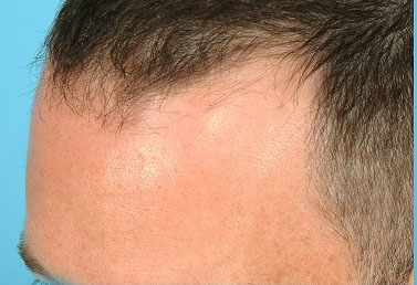 زراعة الشعر بالتقسيط في السعودية