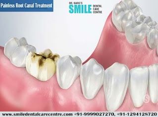 Painless Root Canal Treatment in Faridabad