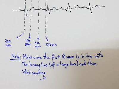 [新しいコレクション] 300 150 ecg method 308697-300 150 ecg rule