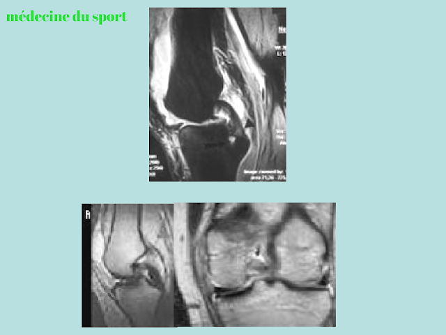 IMAGERIE DU GENOU APPLIQUÉE A LA PATHOLOGIE SPORTIVE