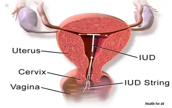 Intrauterine device iud birth control -Your contraception guide