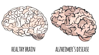 Artikel, Alzheimer, Alzheimer Adalah, Gejala Alzheimer, Diagnosis Alzheimer, Penyebab Alzheimer, Pengobatan Alzheimer