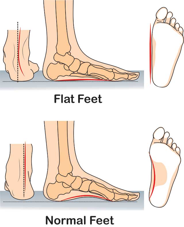Pes Planus (Flat Foot): Physiotherapy Treatment