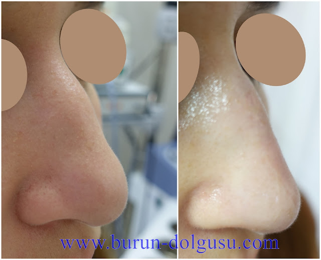 Burun Dolgusu - Dolguyla Burun estetiği - Non-surgical Nose Job In Istanbul - Dolgu İle Burun Ucu Kaldırma - Burun Ucu Dolgusu - Burun Dolgusu Fiyatı - Ameliyatsız Burun Estetiği - Burun Dolgusu Fiyatları - Dolgu İle Burun Kaldırma