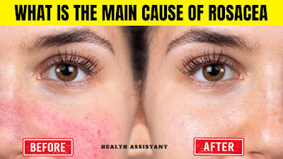 What Causes Rosacea | What Is The Main Cause Of Rosacea |What Helps Rosacea | How To Get Rid Of Rosacea Permanently