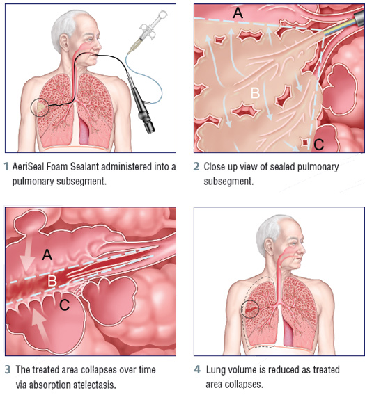 worms in humans. intestinal worms in humans