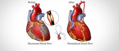 Heart Bypass Surgery In Delhi