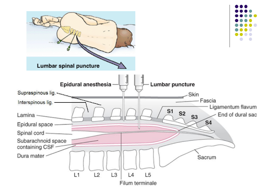 St mathew university school university,lumbar puncture