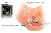 Как сделать УЗИ предстательной железы