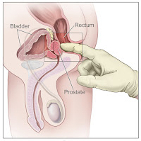 肛門指診 Digital rectal examination, DRE