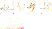 Mastopexy - Breast Lift Scars