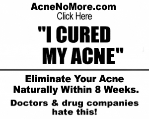 No Mare Acne