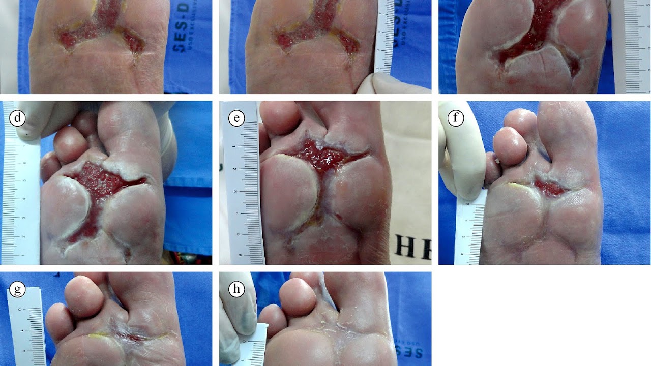 How To Heal A Diabetic Foot Ulcer