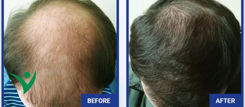 A Comprehensive Solution for Natural Hair Growth and Hair Loss Prevention