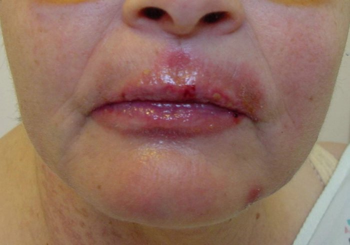 herpes symptoms women. HERPES MOUTH SYMPTOMS