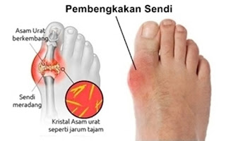 Pengobatan Asam Urat Secara Alamiah, Makanan Pencegah Asam Urat Dan Rematik, Kolestrol Asam Urat Darah Tinggi, Cara Mengobati Asam Urat Secara Alamiah, Pantangan Tuk Asam Urat, Cara Alami Mengobati Asam Urat Pada Ibu Hamil, Penatalaksanaan Asam Urat Akut, Penyakit Asam Urat Di Telapak Kaki, Cara Membuat Obat Alami Untuk Asam Urat, Fungsi Asam Urat Didalam Tubuh, Obat Sakit Ginjal Dan Asam Urat, Cari Herbal Asam Urat, Gejala Asam Urat Lutut, Herbal Alami Untuk Mengobati Asam Urat, Jamu Tradisional Untuk Asam Urat Dan Kolesterol, Asam Urat Batu Ginjal, Jeruk Nipis Untuk Asam Urat Dan Kolesterol, Jinten Hitam Asam Urat, Asam Urat Tidak Boleh Diurut, Herbal Pencegah Asam Urat, Asam Urat Telapak Kaki Sakit, Rentang Asam Urat Normal, Ciri Penyakit Asam Urat Dan Rematik, Apa Penyebab Asam Urat Dan Bagaimana Mengatasinya, Cara Penyembuhan Tradisional Asam Urat, Penyebab Dan Cara Mengobati Asam Urat Secara Alami, Pantangan Asam Urat Nanas, Menghilangkan Bengkak Di Kaki Karena Asam Urat, Cara Cek Asam Urat, Obat Alami Untuk Gejala Asam Urat 