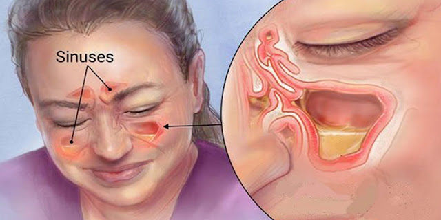 Sinusitis - Watch This Simple Method To Release Paranasal Sinus And Congestion Of The Nose In 20 Seconds