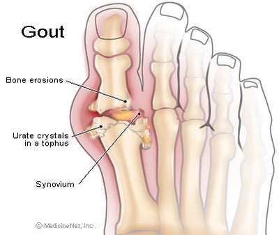 about gout gout is an arthritic meaning inflammation of the joint ...