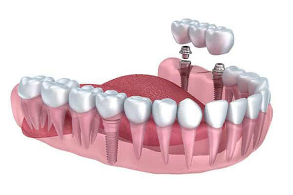 Intramucosal Implants